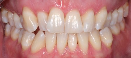 Patient's smile with slightly crooked teeth before dental work.
