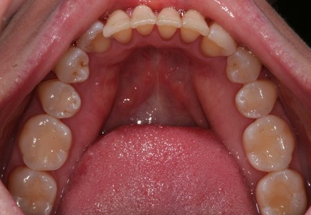 Patient's straight bottom row teeth after dental work.