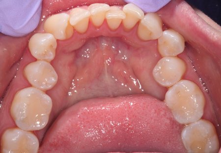 Patient's crooked bottom row teeth before dental work.