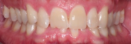 Patient's smile with yellow teeth before teeth whitening.