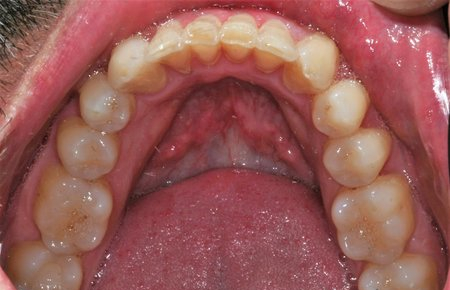 Patient's crooked bottom row teeth after dental work.