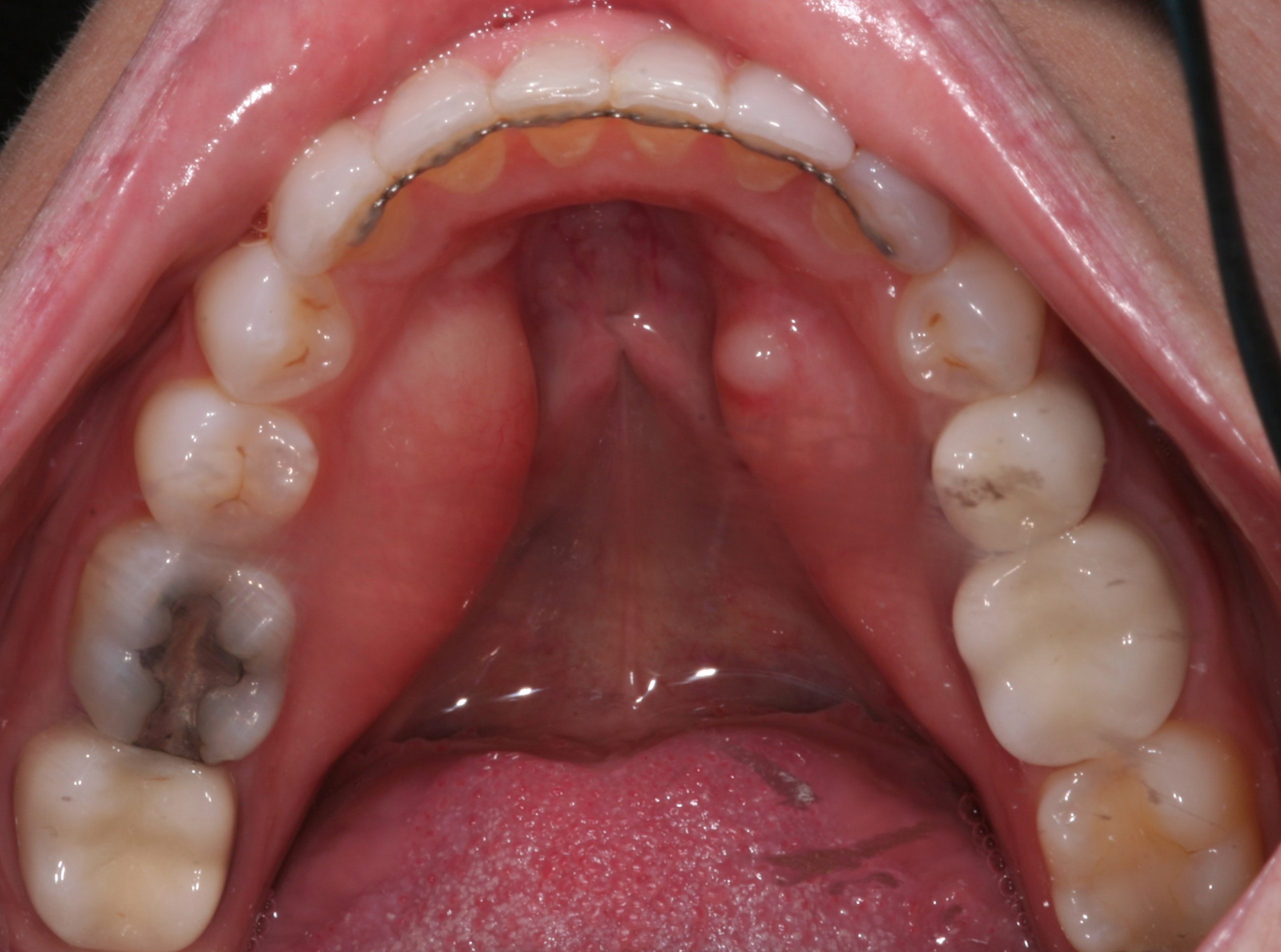 Patient's straight bottom row teeth without cavities after dental work.