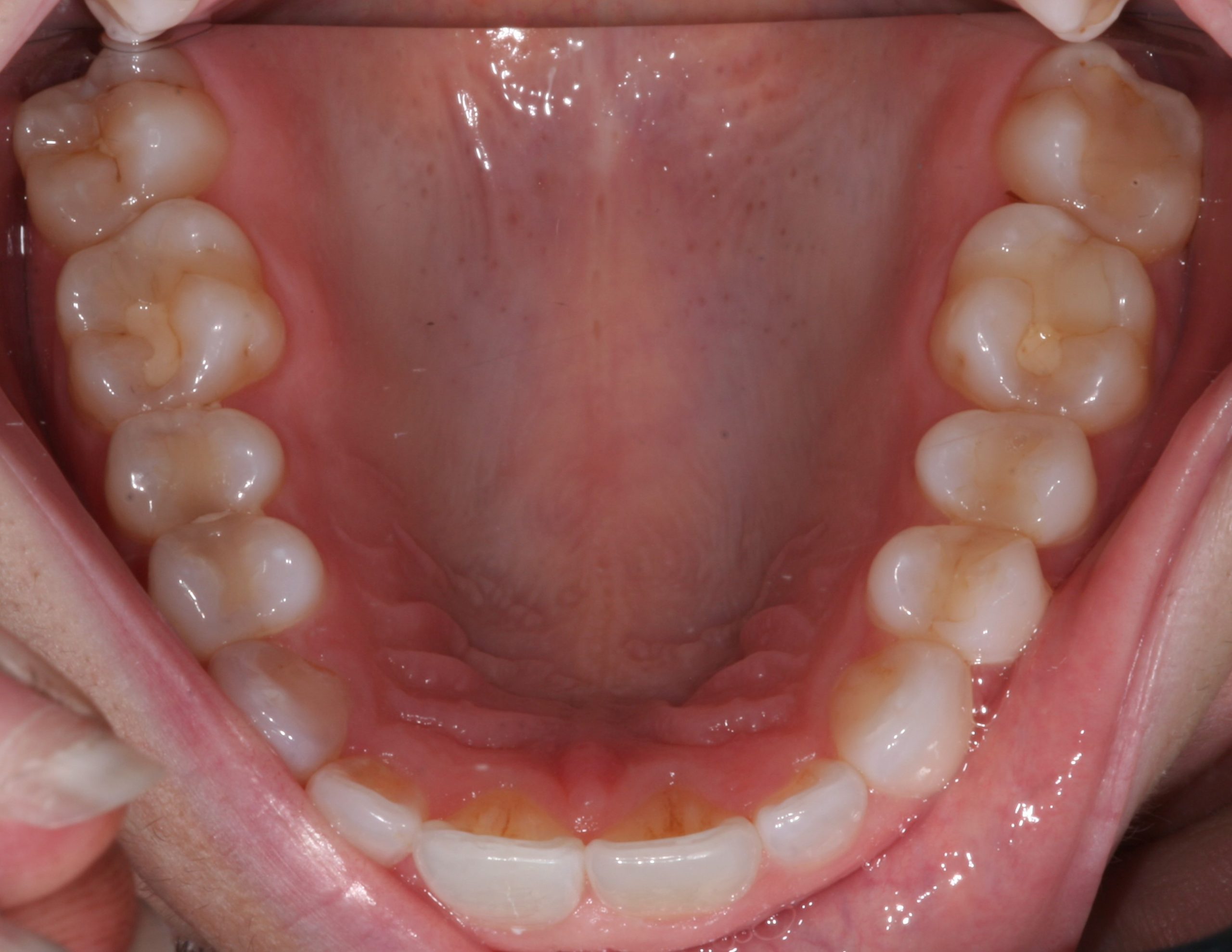 Patient's straight top row teeth after dental work.