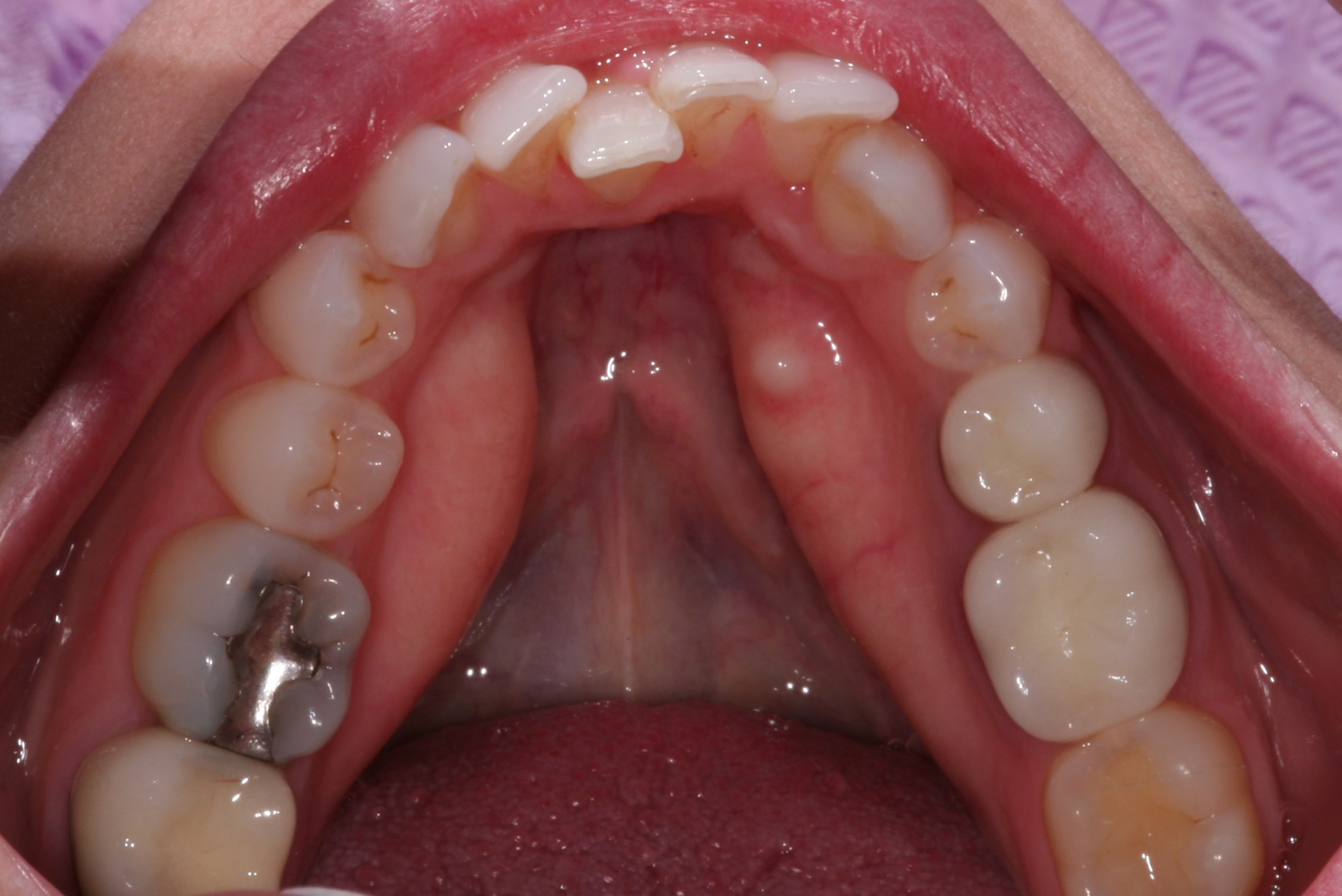 Patient's crooked bottom row teeth with cavities before dental work.