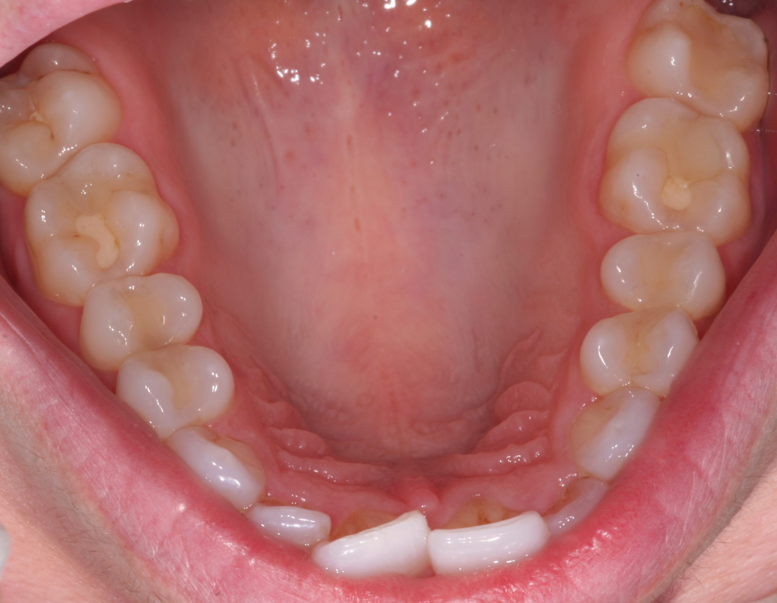 Patient's crooked top row teeth before dental work.